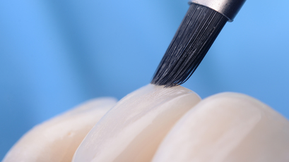 Composite Veneers