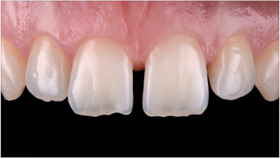 Proximal Composite Reconstruction